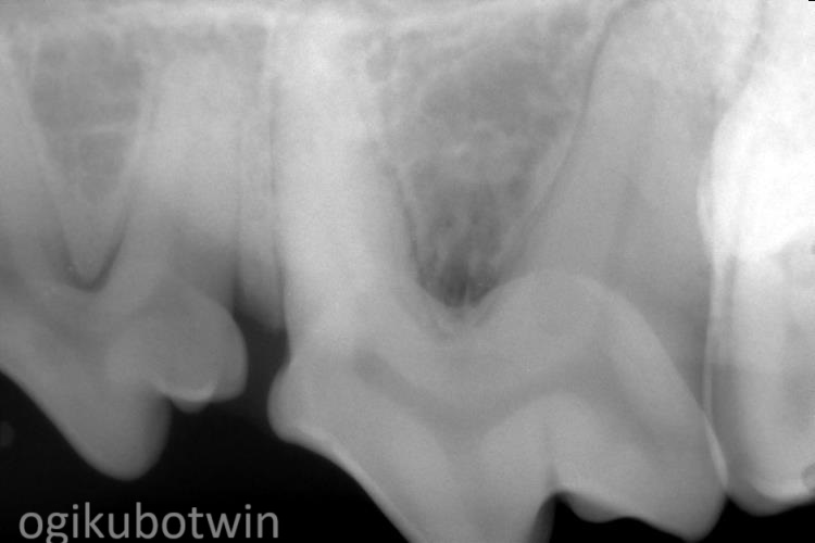 犬の奥歯　再生治療　治療後